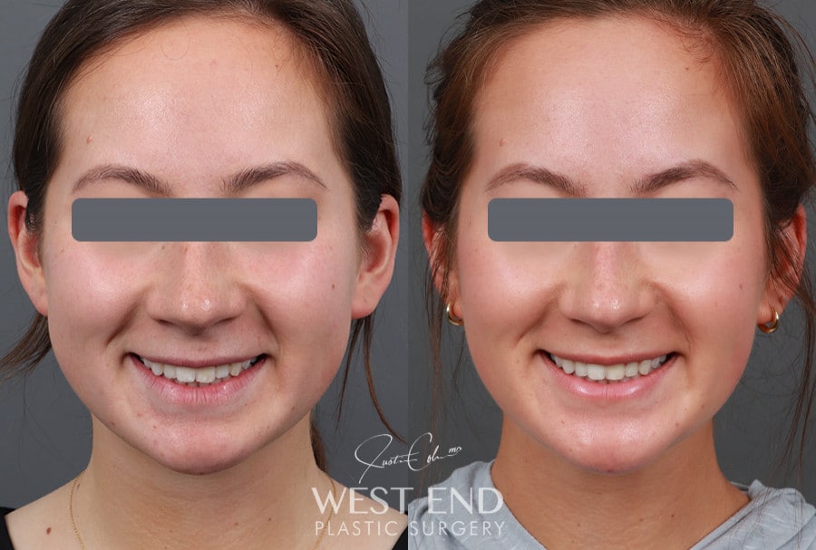 Neck Liposuction, Buccal Fat Reduction, & Chin Implant before photo. Individual results may vary.