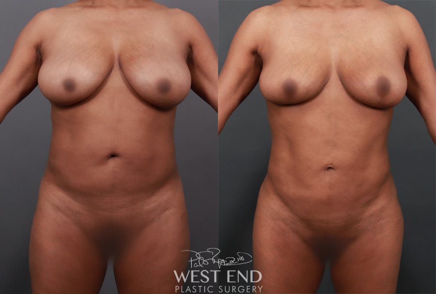 Breast Lift, Liposuction, Renuvion Skin Tightening, & Brazilian Butt Lift