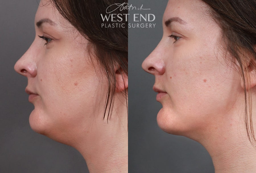 Submental & Neck Liposuction