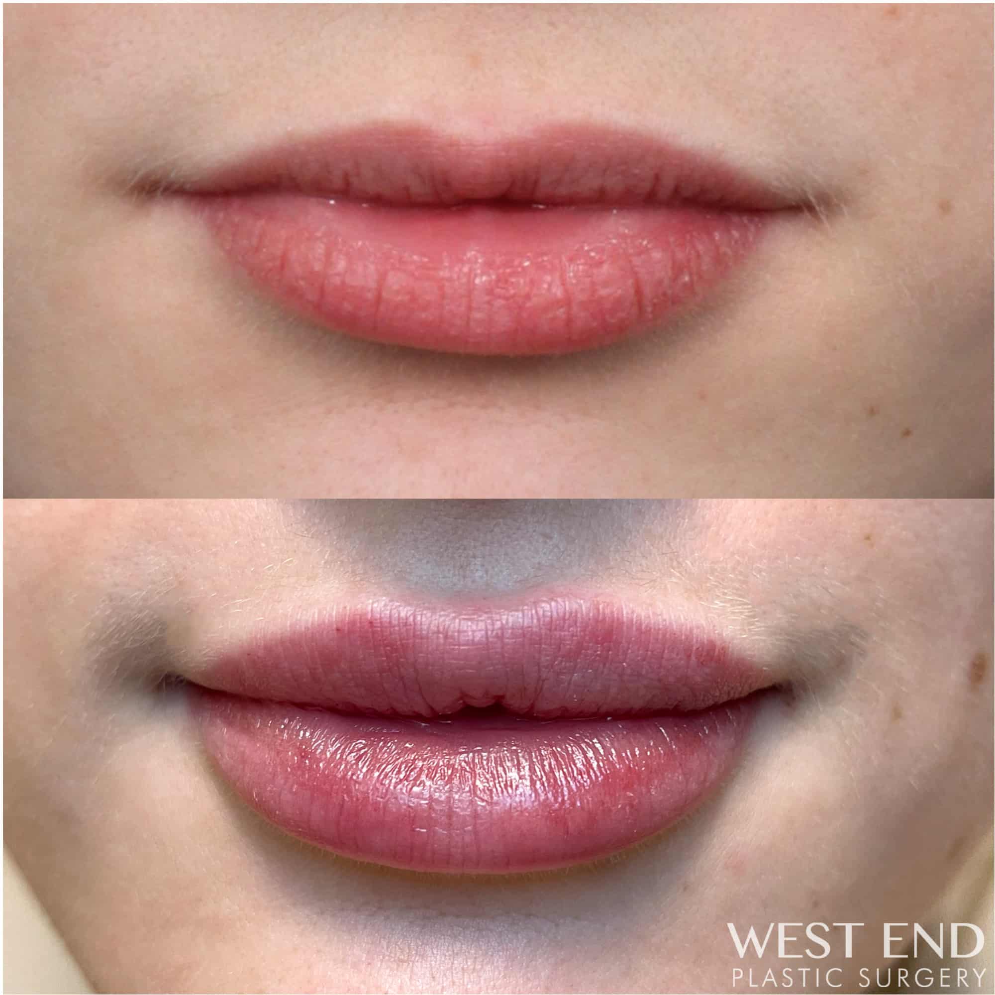 Lip Filler