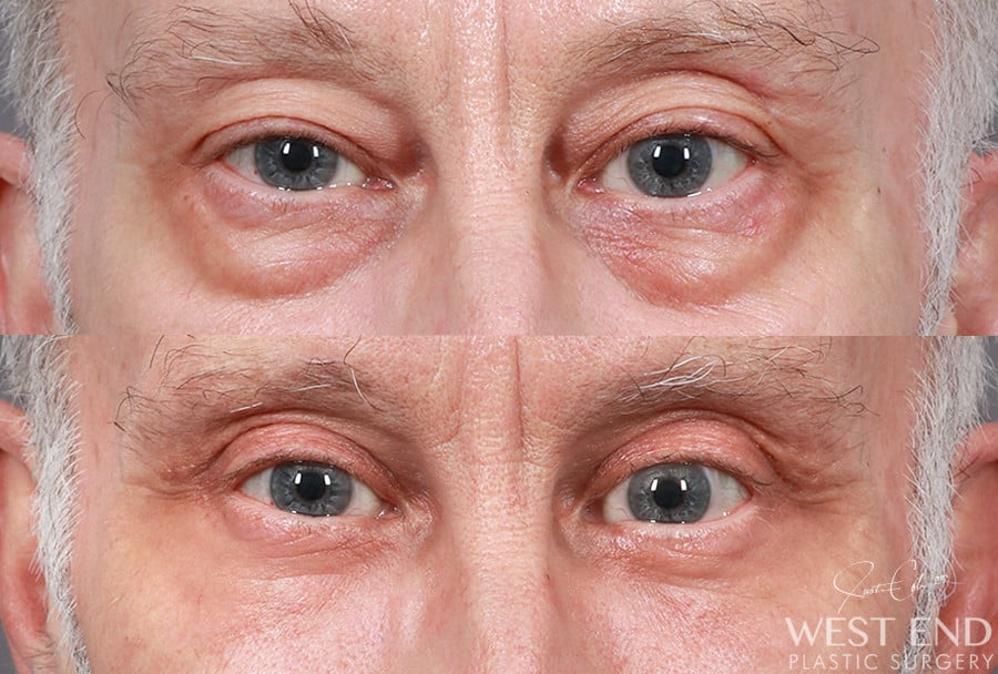 Blepharoplasty before photo. Individual results may vary.