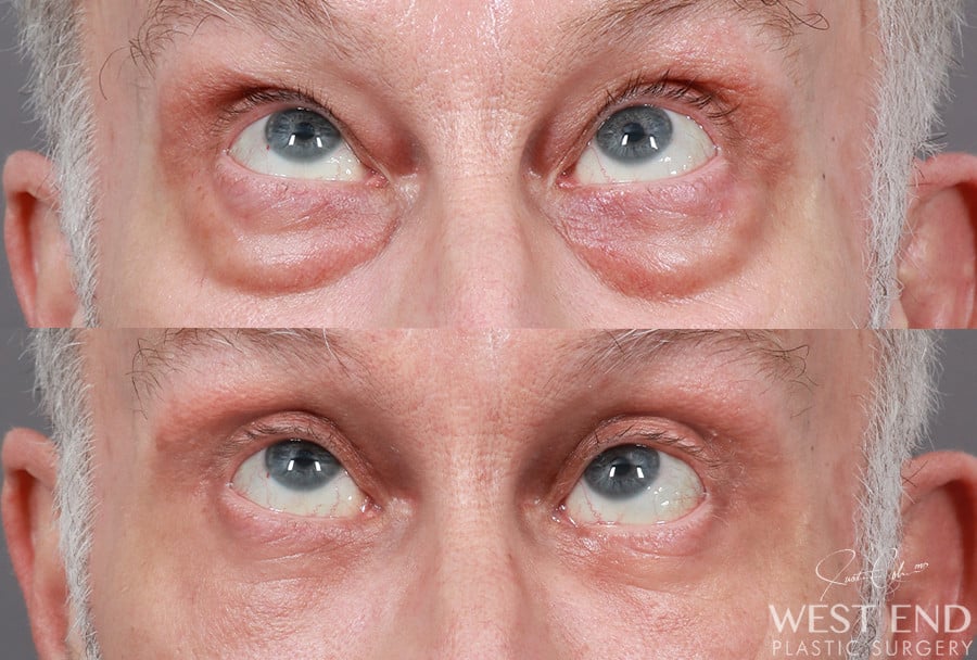 Blepharoplasty before photo. Individual results may vary.