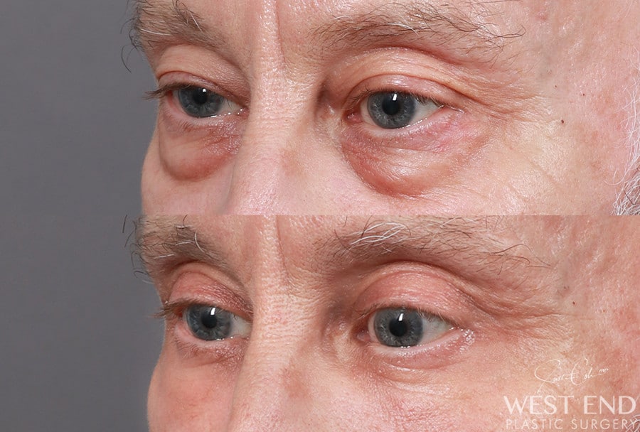 Blepharoplasty before photo. Individual results may vary.