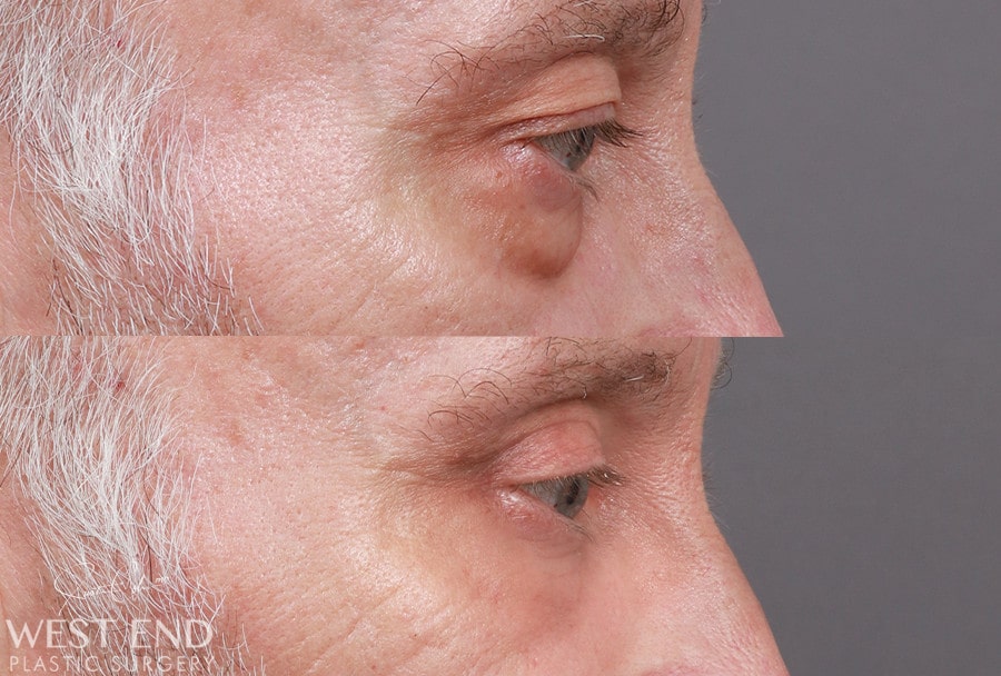 Blepharoplasty before photo. Individual results may vary.