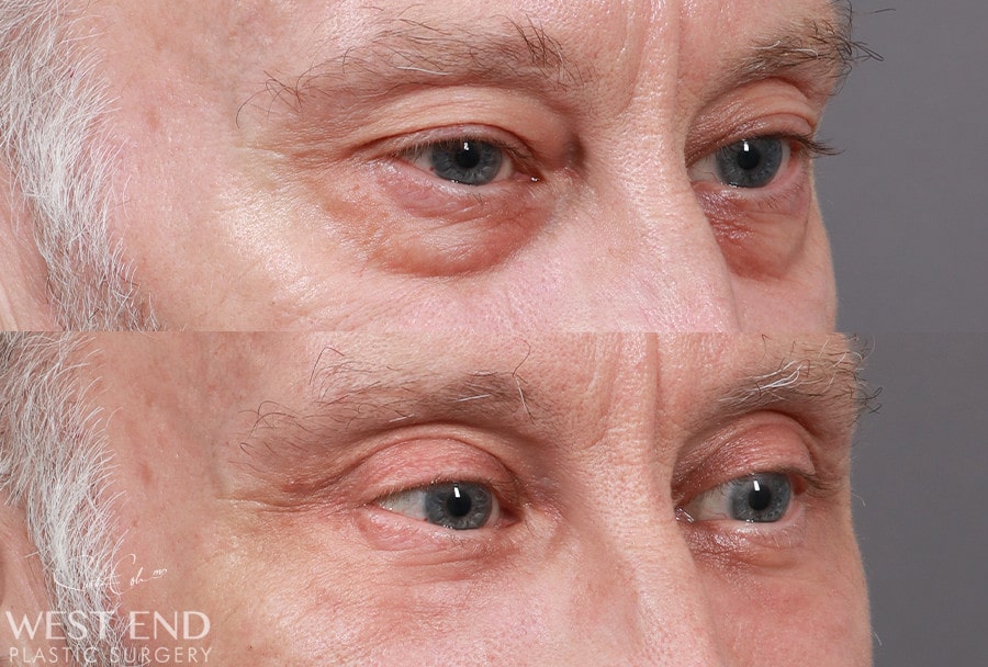 Blepharoplasty before photo. Individual results may vary.