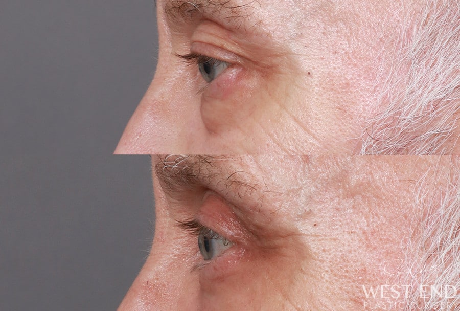 Blepharoplasty before photo. Individual results may vary.