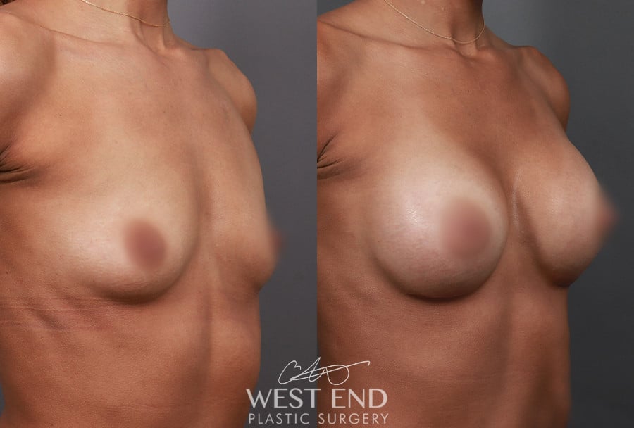 Before Image: Breast Augmentation - right-front-oblique