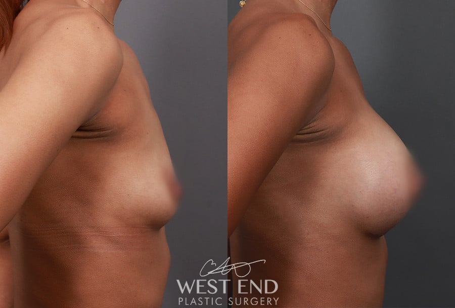 Before Image: Breast Augmentation - right-side