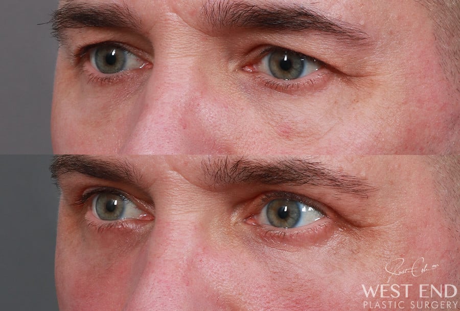Blepharoplasty before photo. Individual results may vary.