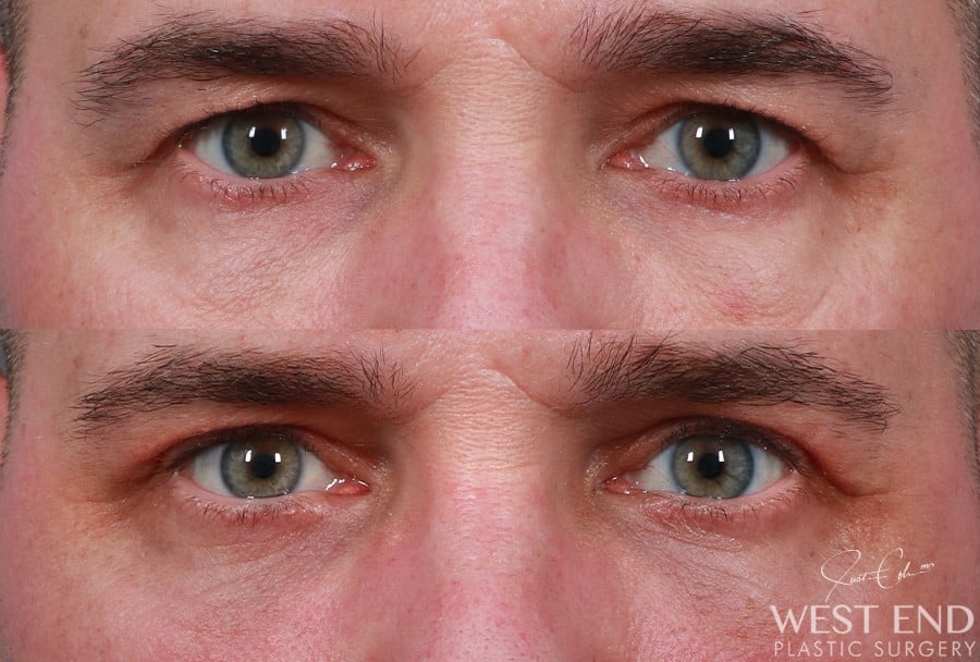 Blepharoplasty before photo. Individual results may vary.