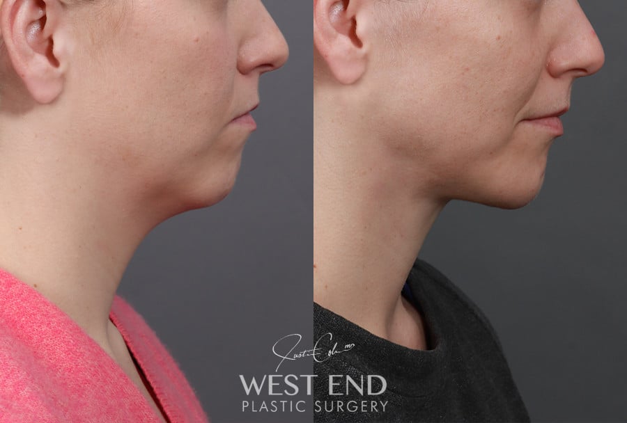 Deep Neck Lift with Platysmaplasty & Chin Implant before photo. Individual results may vary.