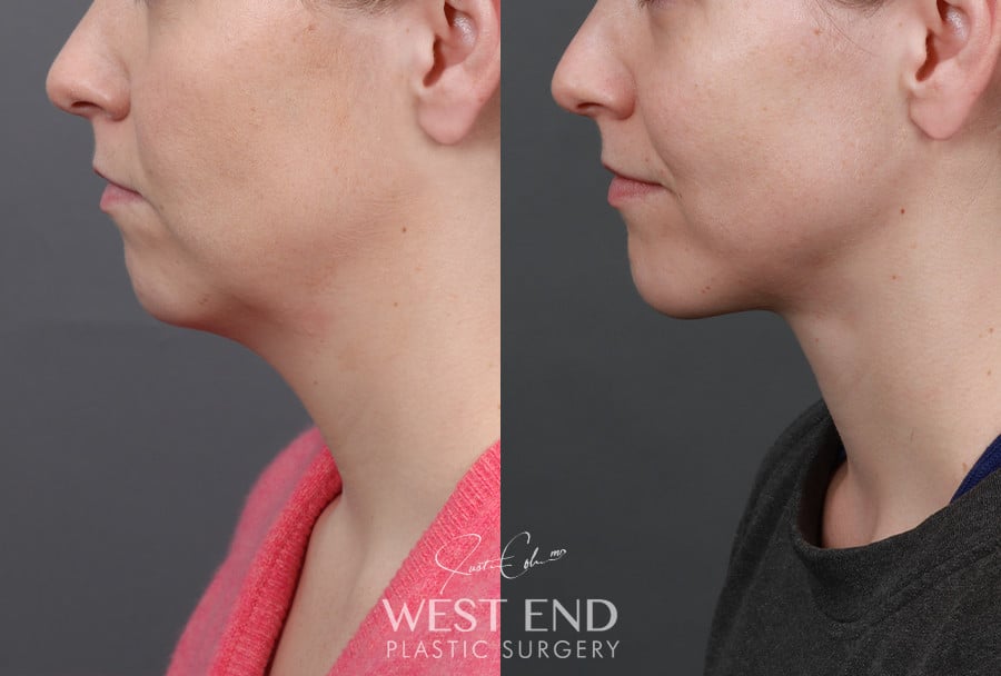 Deep Neck Lift with Platysmaplasty & Chin Implant before photo. Individual results may vary.