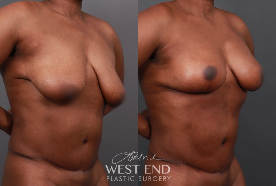 Breast Lift with Fat Grafting & Liposuction