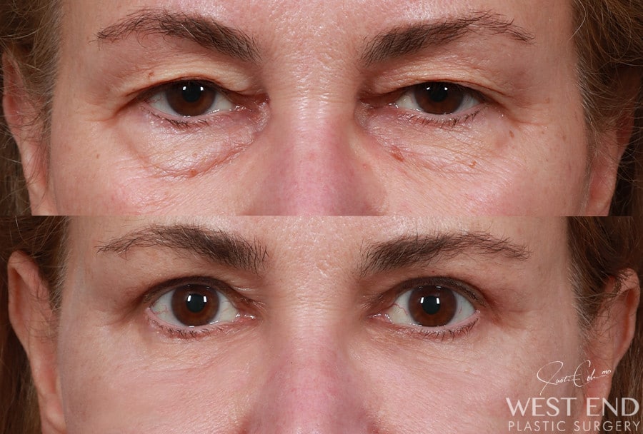 Blepharoplasty, Fat Grafting & CO2 Laser Resurfacing before photo. Individual results may vary.