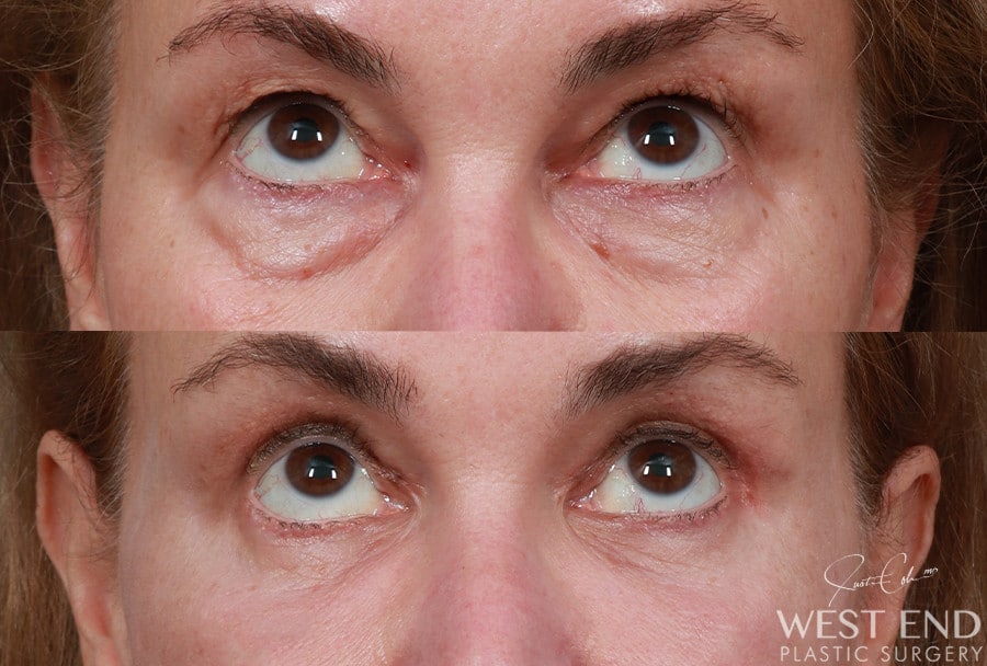 Blepharoplasty, Fat Grafting & CO2 Laser Resurfacing before photo. Individual results may vary.