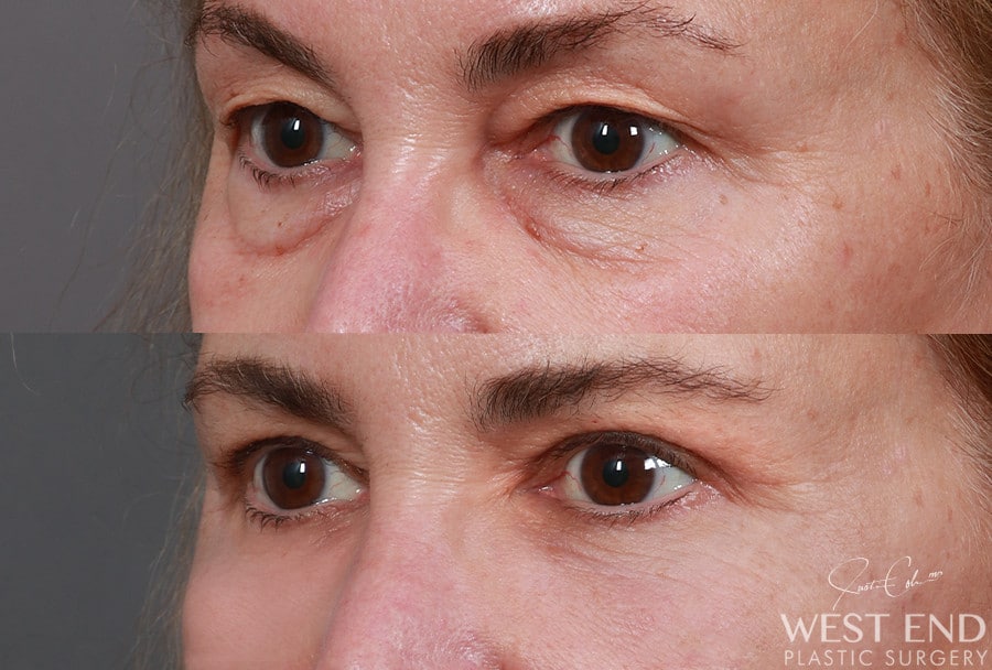 Blepharoplasty, Fat Grafting & CO2 Laser Resurfacing before photo. Individual results may vary.