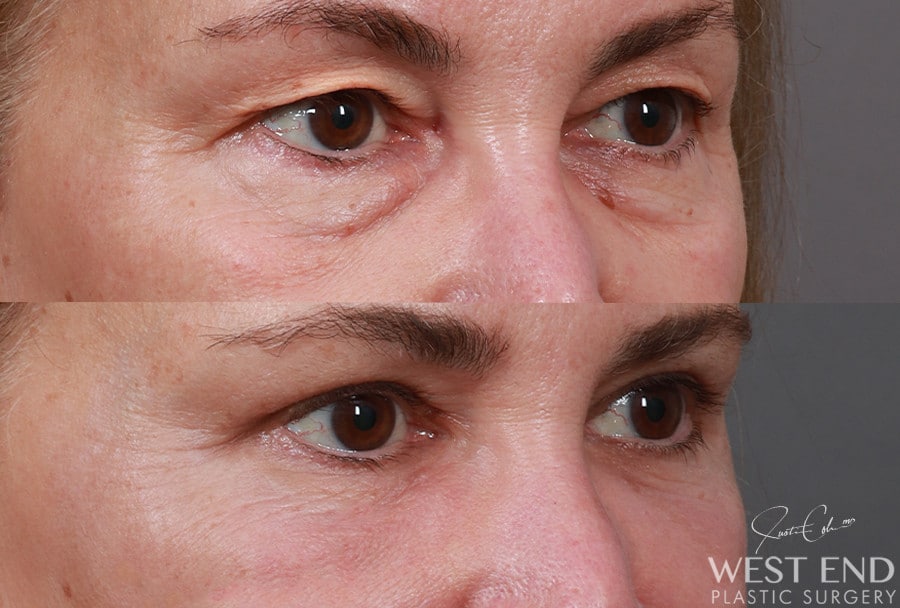 Blepharoplasty, Fat Grafting & CO2 Laser Resurfacing before photo. Individual results may vary.