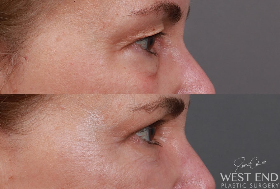 Blepharoplasty, Fat Grafting & CO2 Laser Resurfacing before photo. Individual results may vary.