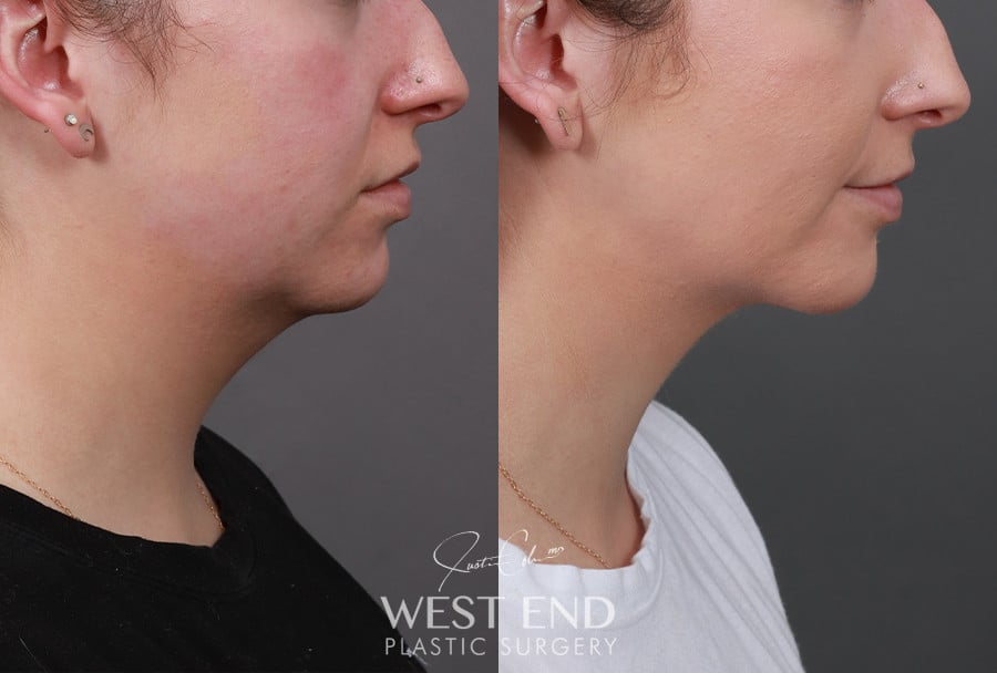 Submentoplasty with Liposuction before photo. Individual results may vary.