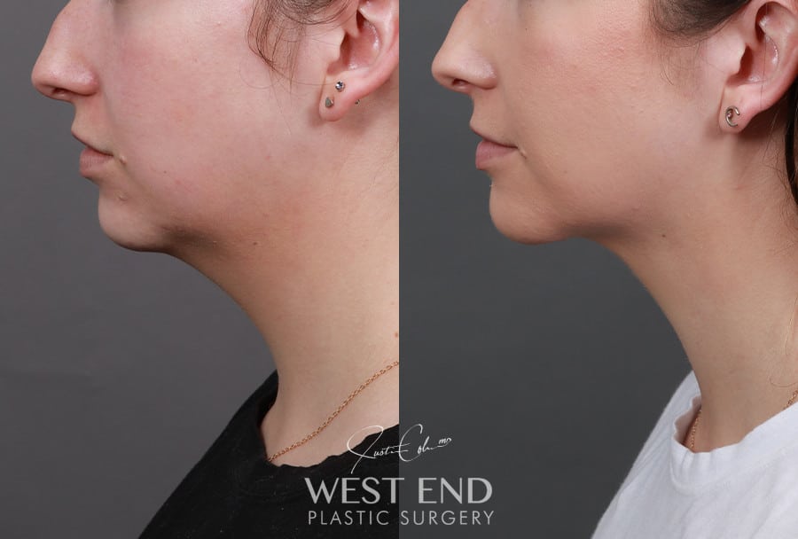 Submentoplasty with Liposuction before photo. Individual results may vary.