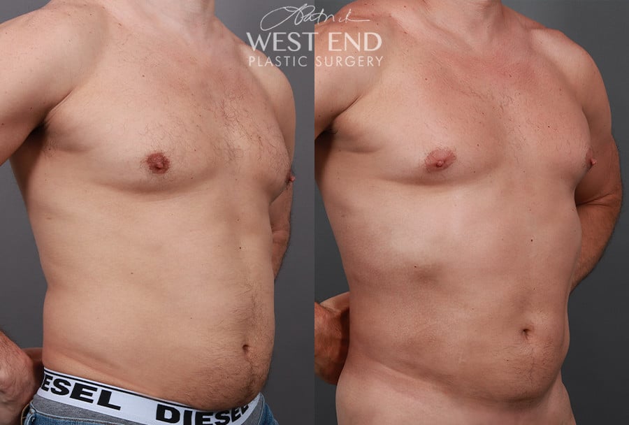 Liposuction and Renuvion Skin Tightening
