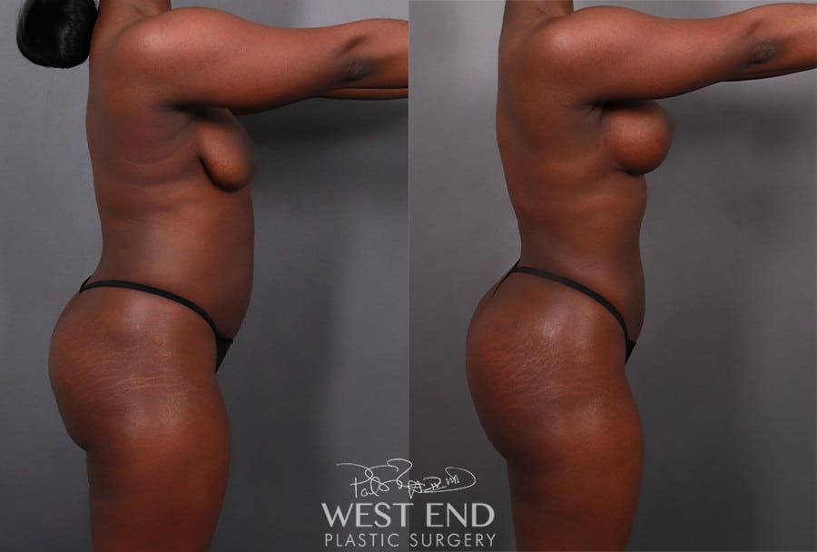Mommy Makeover (Brazilian Butt Lift, Breast Lift with an Implant Exchange, Liposuction, & Renuvion Skin Tightening)