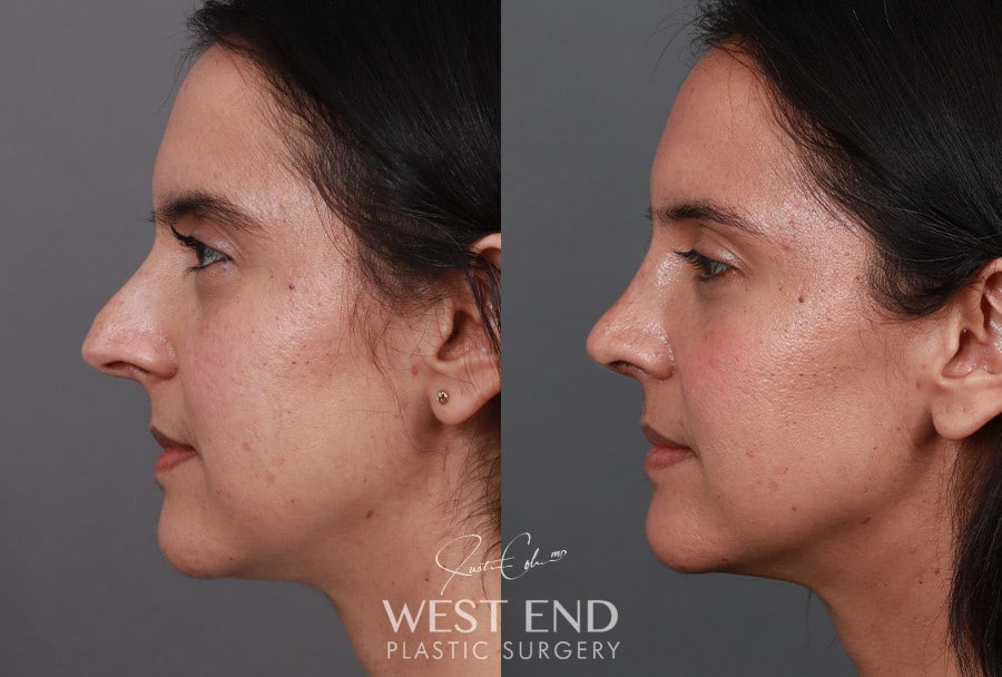 Rhinoplasty before photo. Individual results may vary.
