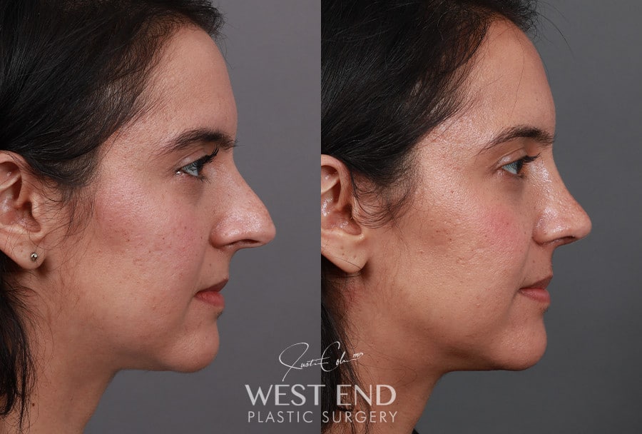 Rhinoplasty before photo. Individual results may vary.