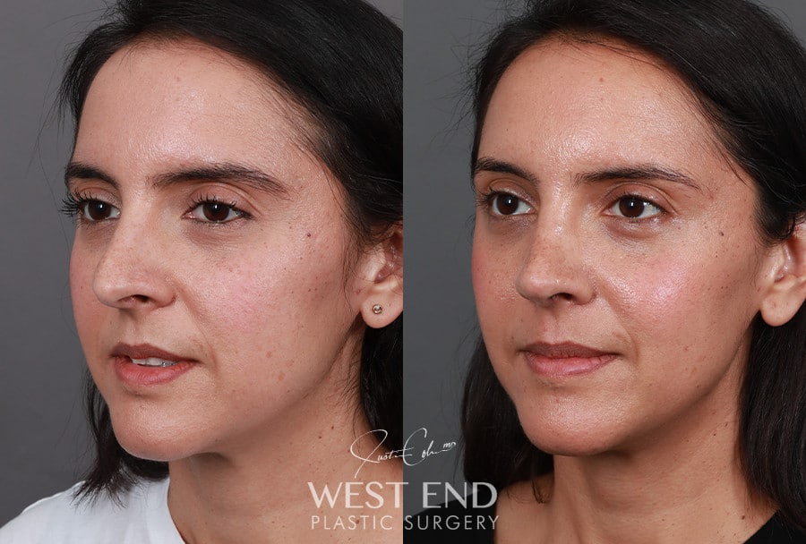 Rhinoplasty before photo. Individual results may vary.