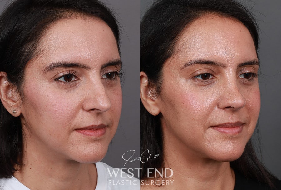 Rhinoplasty before photo. Individual results may vary.