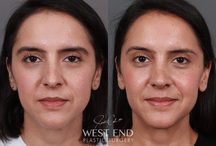 Rhinoplasty before photo. Individual results may vary.