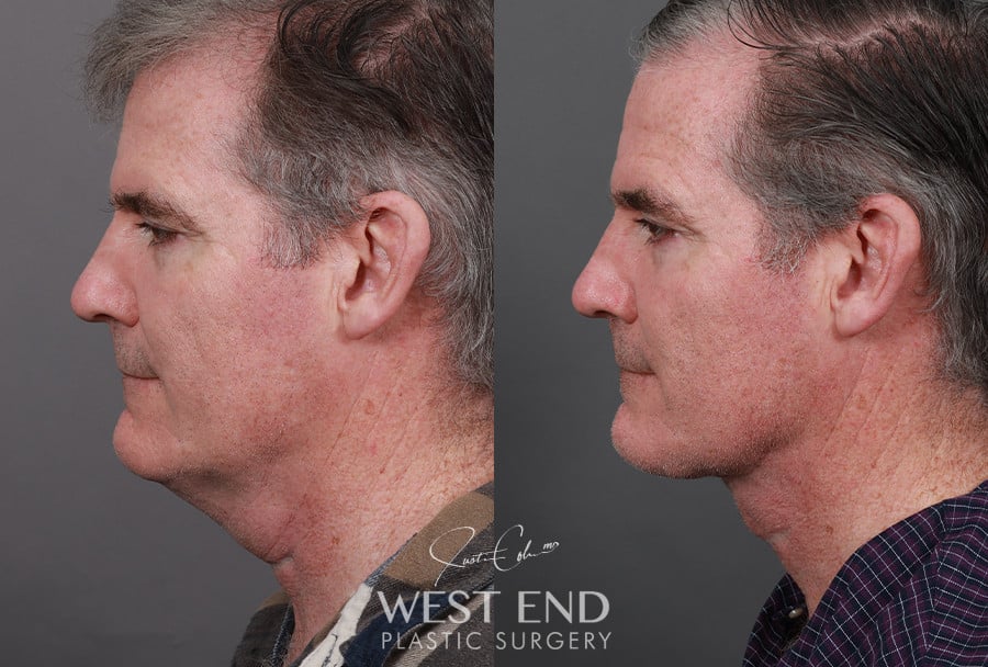 Direct Neck Excision with Deep Neck Lift Sculpting before photo. Individual results may vary.