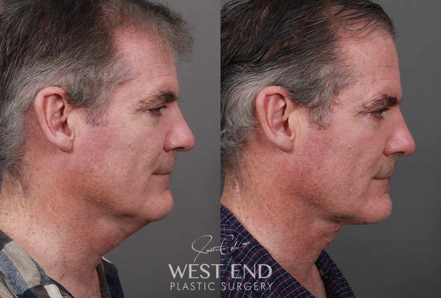 Direct Neck Excision with Deep Neck Lift Sculpting before photo. Individual results may vary.