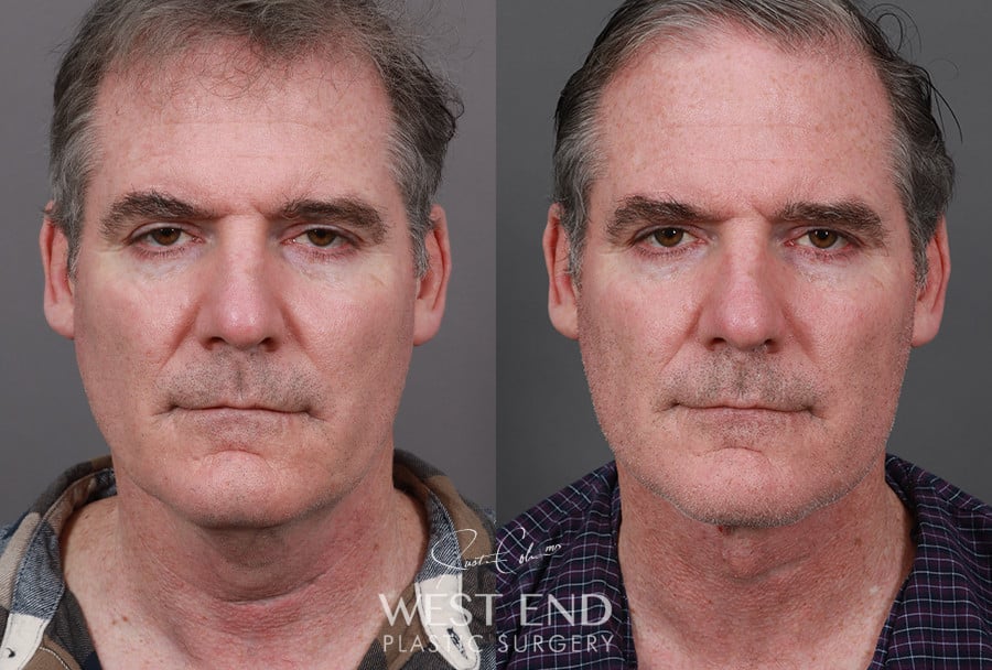 Direct Neck Excision with Deep Neck Lift Sculpting before photo. Individual results may vary.