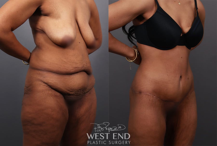 Post Weight Loss: Lower Body Lift, Liposuction & Renuvion Skin Tightening