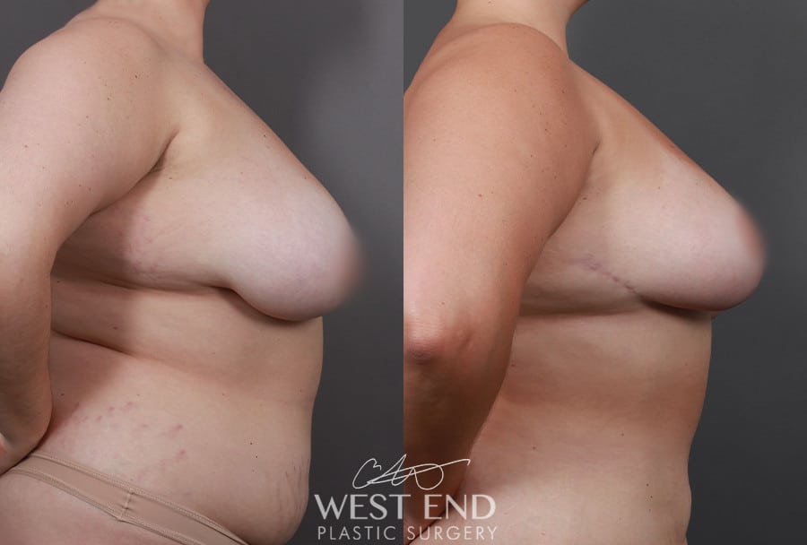 Breast Reduction & Liposuction