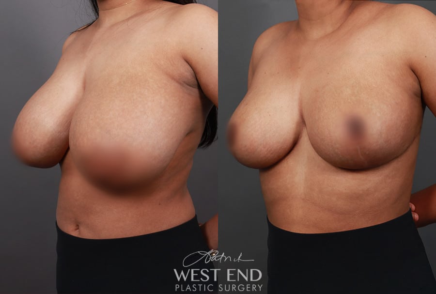 Breast Reduction (2 Months Post-Op)