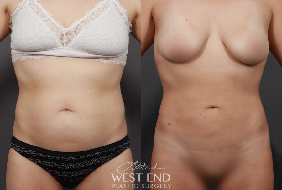 Liposuction and Renuvion Skin Tightening