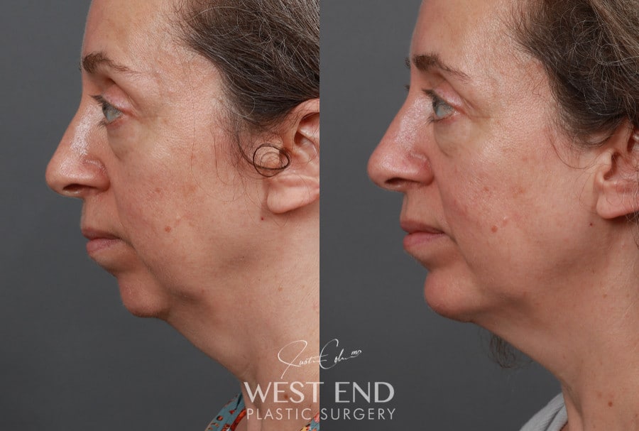 Chin Implant before photo. Individual results may vary.