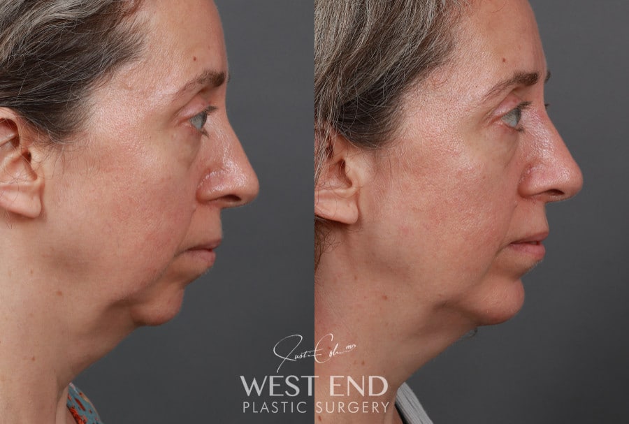 Chin Implant before photo. Individual results may vary.