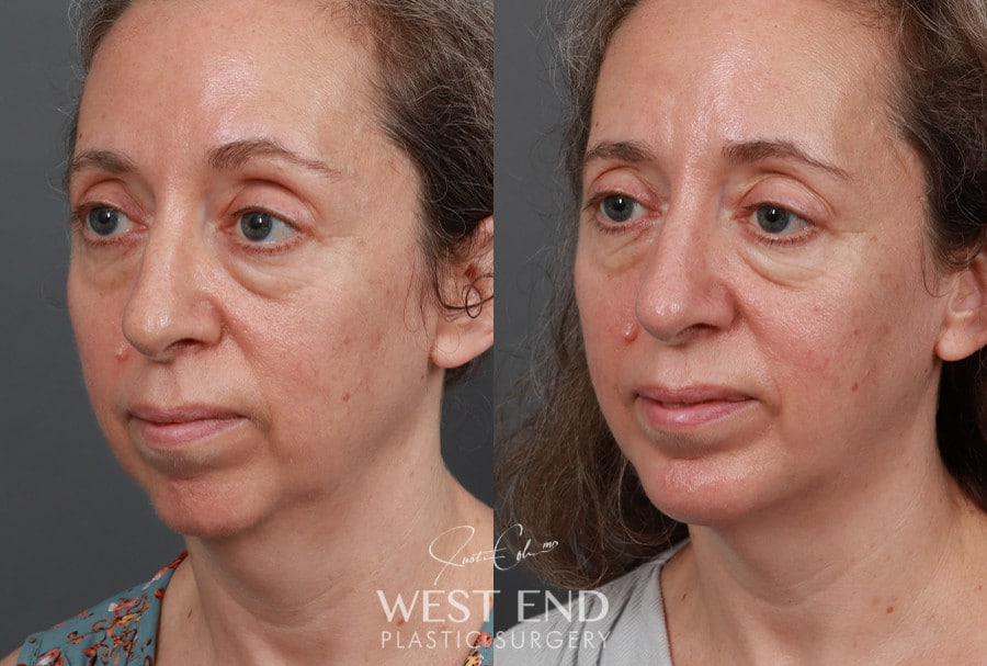 Chin Implant before photo. Individual results may vary.