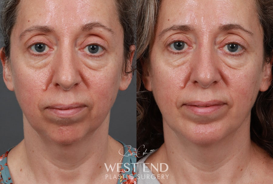 Chin Implant before photo. Individual results may vary.
