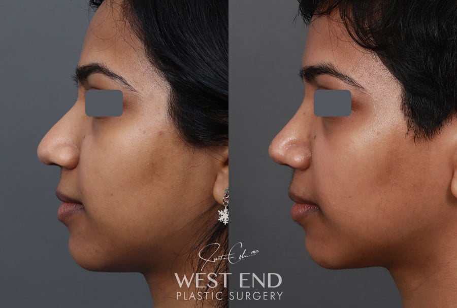 Rhinoplasty before photo. Individual results may vary.