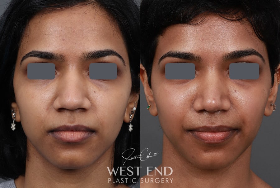 Rhinoplasty before photo. Individual results may vary.