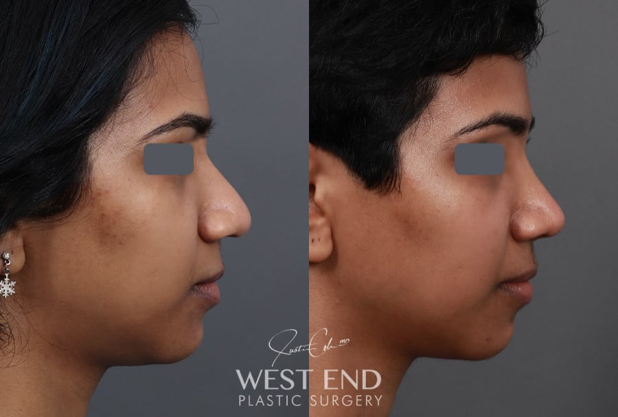 Rhinoplasty before photo. Individual results may vary.