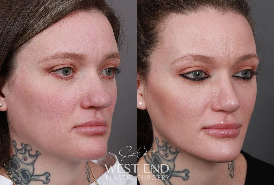 Rhinoplasty before photo. Individual results may vary.
