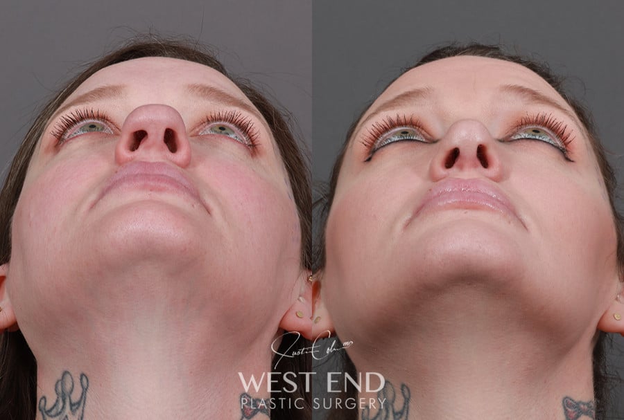 Rhinoplasty before photo. Individual results may vary.