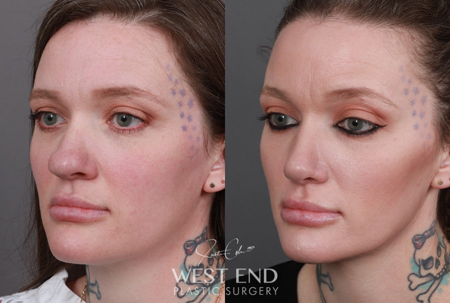 Rhinoplasty before photo. Individual results may vary.