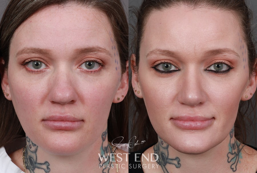 Rhinoplasty before photo. Individual results may vary.