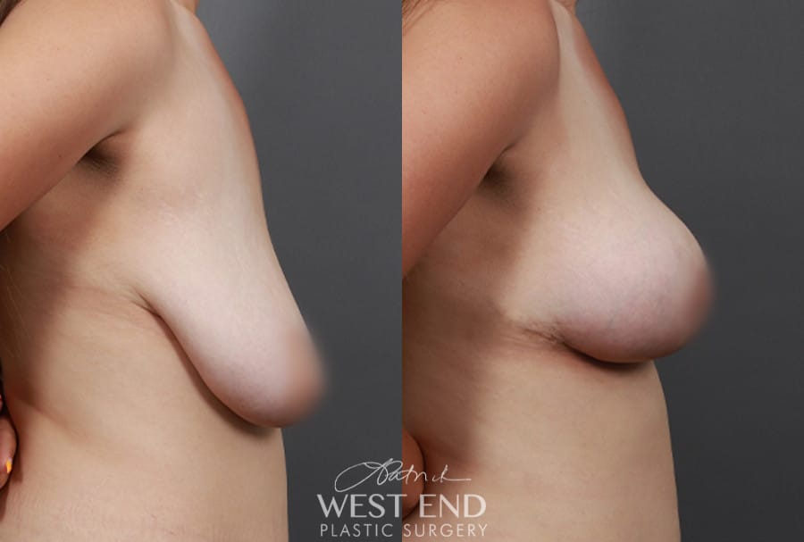 Breast Reduction